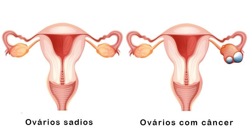Câncer de ovário